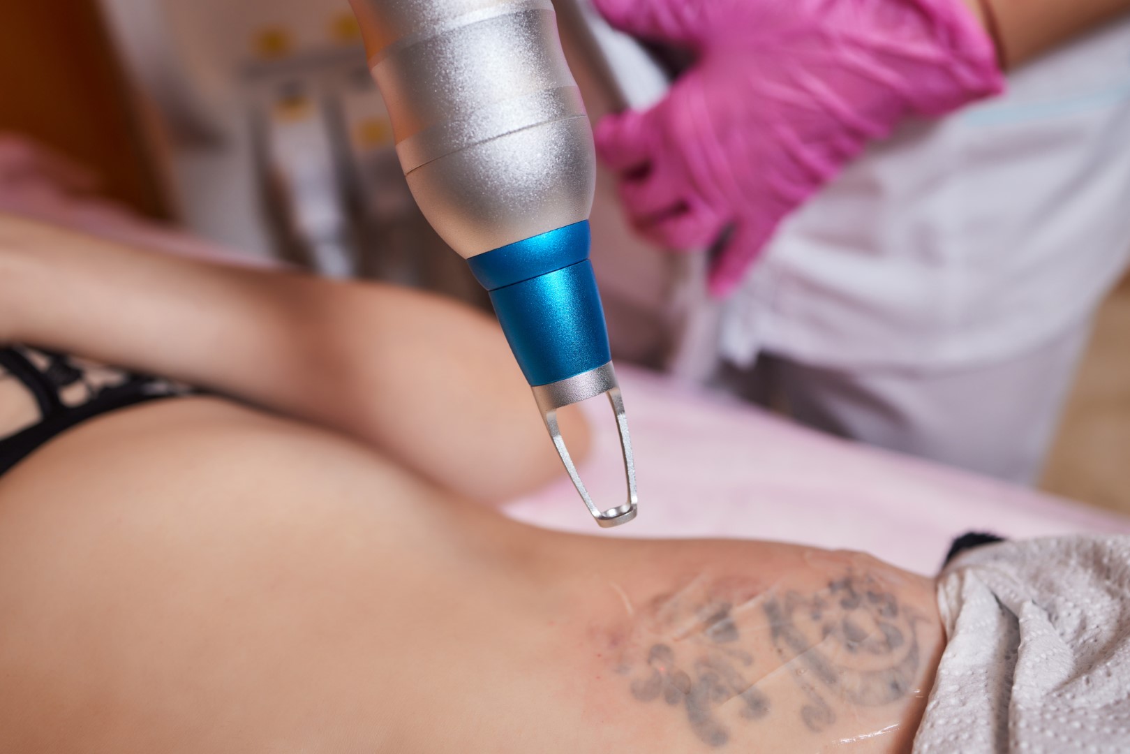 Laser Tattoo Removal Treatment in Sacramento CA