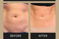 Emsculpt Before and After-19