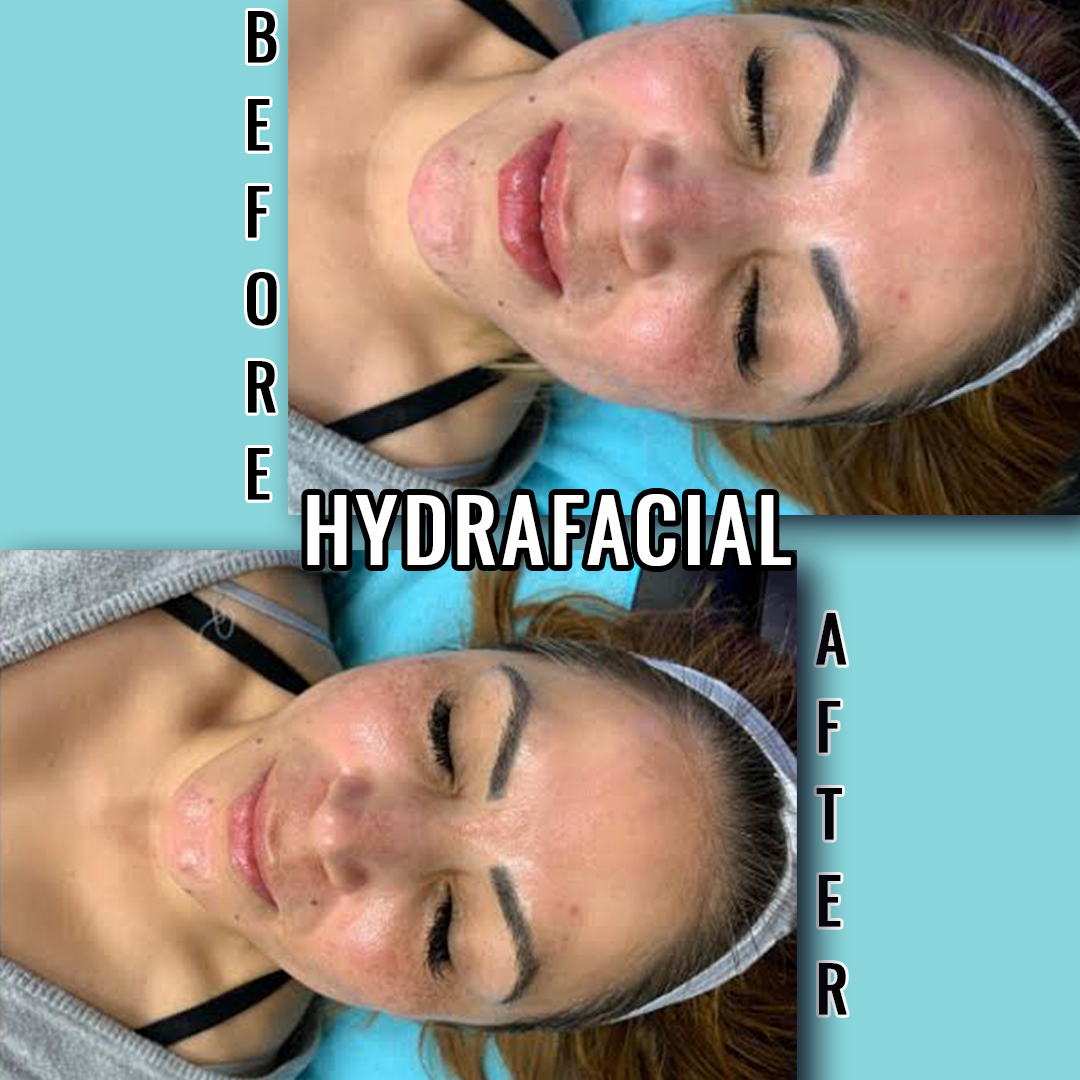 hydrafacial before after