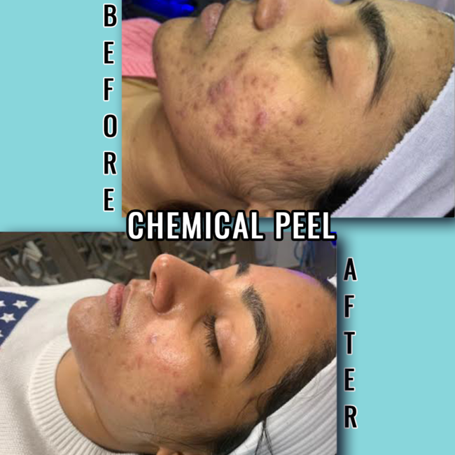 chemical peels before after